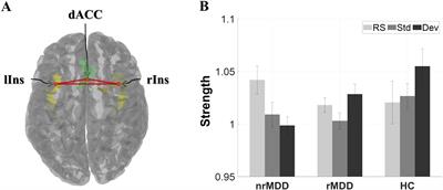 Prediction of pharmacological treatment efficacy using electroencephalography-based salience network in patients with major depressive disorder